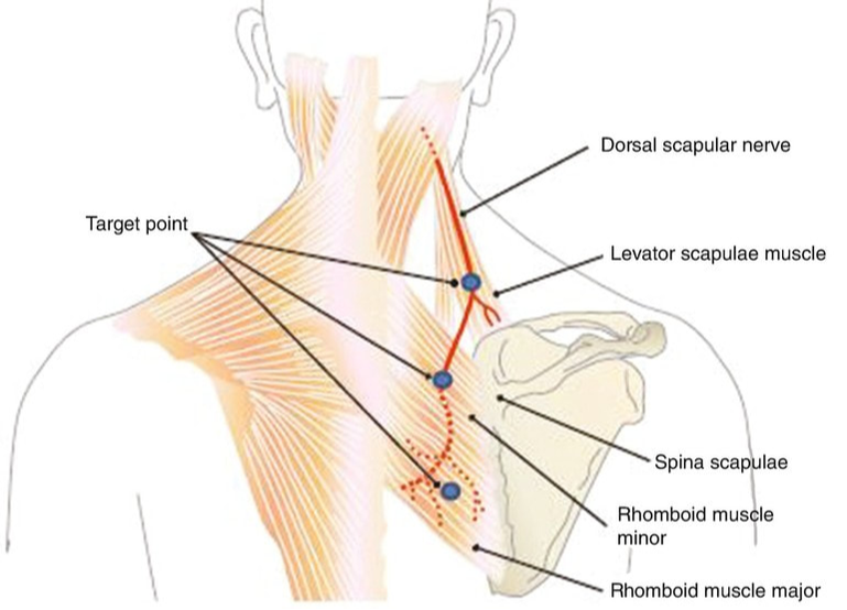Achy Breaky Midback Pain: Dorsal Scapular Nerve Entrapment Nurture